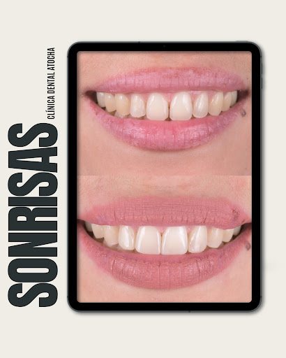 Clínica Dental Atocha. Ortodoncia e Implantes Dentales Madrid — SALUD en Madrid